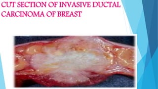 CUT SECTION OF INVASIVE DUCTAL
CARCINOMA OF BREAST
 
