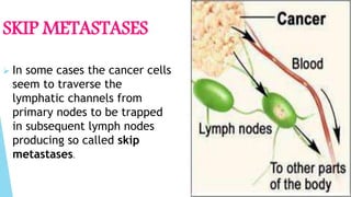 SKIP METASTASES
 In some cases the cancer cells
seem to traverse the
lymphatic channels from
primary nodes to be trapped
in subsequent lymph nodes
producing so called skip
metastases.
 
