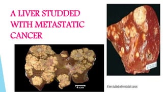 A LIVER STUDDED
WITH METASTATIC
CANCER
 