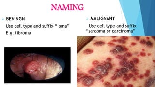NAMING
 BENINGN
Use cell type and suffix “ oma”
E.g. fibroma
 MALIGNANT
Use cell type and suffix
“sarcoma or carcinoma”
 