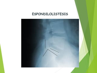 ESPONDILOLISTESIS
 