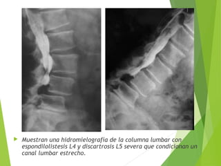  Muestran una hidromielografía de la columna lumbar con
espondilolistesis L4 y discartrosis L5 severa que condicionan un
canal lumbar estrecho.
 
