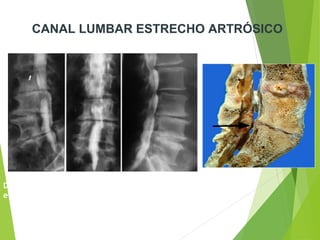 Discopatías con protrusiones discales y osteofitos
evidenciados por la Mielografía
CANAL LUMBAR ESTRECHO ARTRÓSICO
 