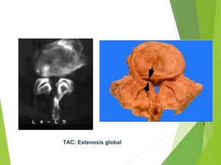TAC: Estenosis global
 