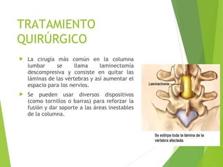  La cirugía más común en la columna
lumbar se llama laminectomía
descompresiva y consiste en quitar las
láminas de las vértebras y así aumentar el
espacio para los nervios.
 Se pueden usar diversos dispositivos
(como tornillos o barras) para reforzar la
fusión y dar soporte a las áreas inestables
de la columna.
TRATAMIENTO
QUIRÚRGICO
 