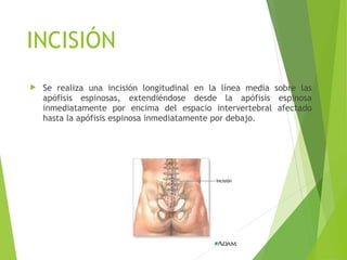  Se realiza una incisión longitudinal en la línea media sobre las
apófisis espinosas, extendiéndose desde la apófisis espinosa
inmediatamente por encima del espacio intervertebral afectado
hasta la apófisis espinosa inmediatamente por debajo.
INCISIÓN
 