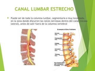 CANAL LUMBAR ESTRECHO
 Puede ser de toda la columna lumbar, segmentaria o muy localizada,
en la zona donde discurren las raíces nerviosas dentro del canal (receso
lateral), antes de salir fuera de la columna vertebral
 