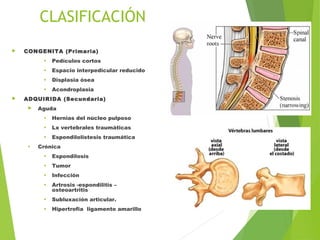 CLASIFICACIÓN
 CONGENITA (Primaria)
• Pedículos cortos
• Espacio interpedicular reducido
• Displasia ósea
• Acondroplasia
 ADQUIRIDA (Secundaria)
 Aguda
• Hernias del núcleo pulposo
• Lx vertebrales traumáticas
• Espondilolistesis traumática
• Crónica
• Espondilosis
• Tumor
• Infección
• Artrosis -espondilitis –
osteoartritis
• Subluxación articular.
• Hipertrofia ligamento amarillo
 