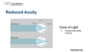 Cone of Light
 Causes less ability
to focus
 