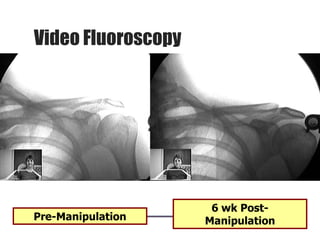 Video Fluoroscopy
6 wk Post-
ManipulationPre-Manipulation
 