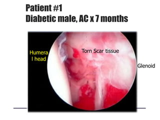 Patient #1
Diabetic male, AC x 7 months
Humera
l head
Torn Scar tissue
Glenoid
 