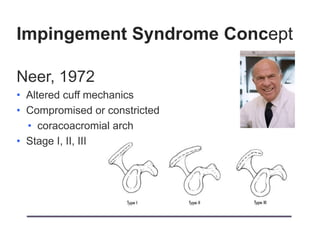Impingement Syndrome Concept
Neer, 1972
• Altered cuff mechanics
• Compromised or constricted
• coracoacromial arch
• Stage I, II, III
 