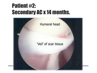 Patient #2:
Secondary AC x 14 months.
Humeral head
„Veil‟ of scar tissue
 