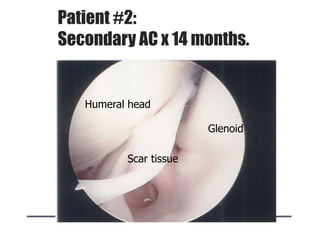 Patient #2:
Secondary AC x 14 months.
Humeral head
Scar tissue
Glenoid
 