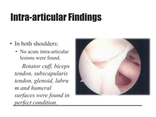 Intra-articular Findings
• In both shoulders:
• No acute intra-articular
lesions were found.
Rotator cuff, biceps
tendon, subscapularis
tendon, glenoid, labru
m and humeral
surfaces were found in
perfect condition.
 