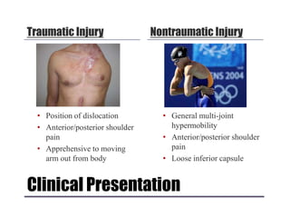 Clinical Presentation
Traumatic Injury
• Position of dislocation
• Anterior/posterior shoulder
pain
• Apprehensive to moving
arm out from body
Nontraumatic Injury
• General multi-joint
hypermobility
• Anterior/posterior shoulder
pain
• Loose inferior capsule
 