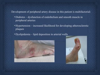 Peripheral Artery Disease - Case Presentation | PPT