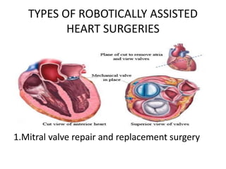 TYPES OF ROBOTICALLY ASSISTED
HEART SURGERIES
1.Mitral valve repair and replacement surgery
 