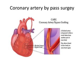 Coronary artery by pass surgey
 