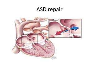 ASD repair
 