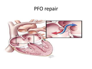 PFO repair
 