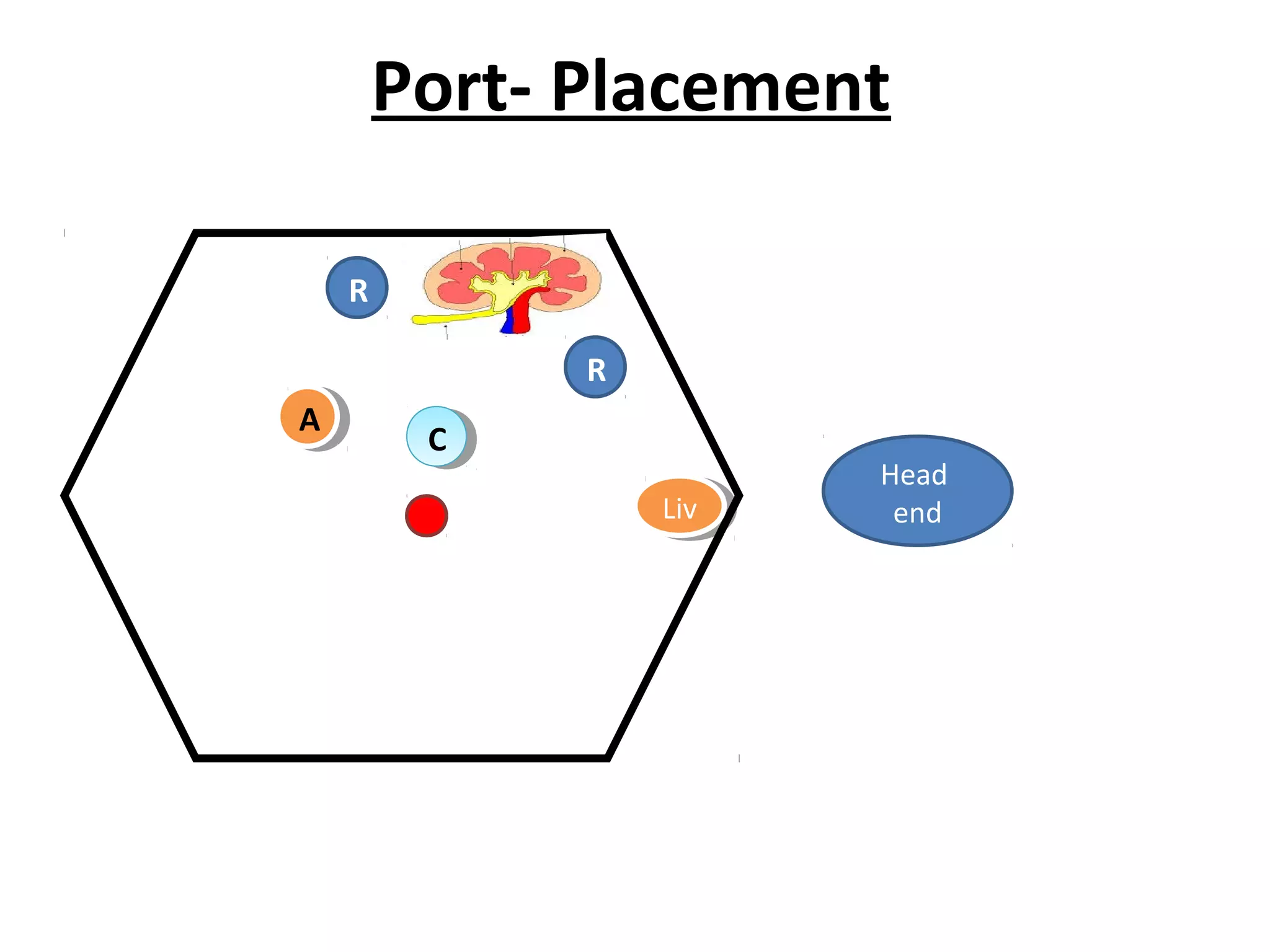 Port- Placement
CC
R
R
LivLiv
AA
Head
end
 