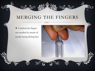 Merging the fingersI stitched the fingers one another by means of needle having fishing line.