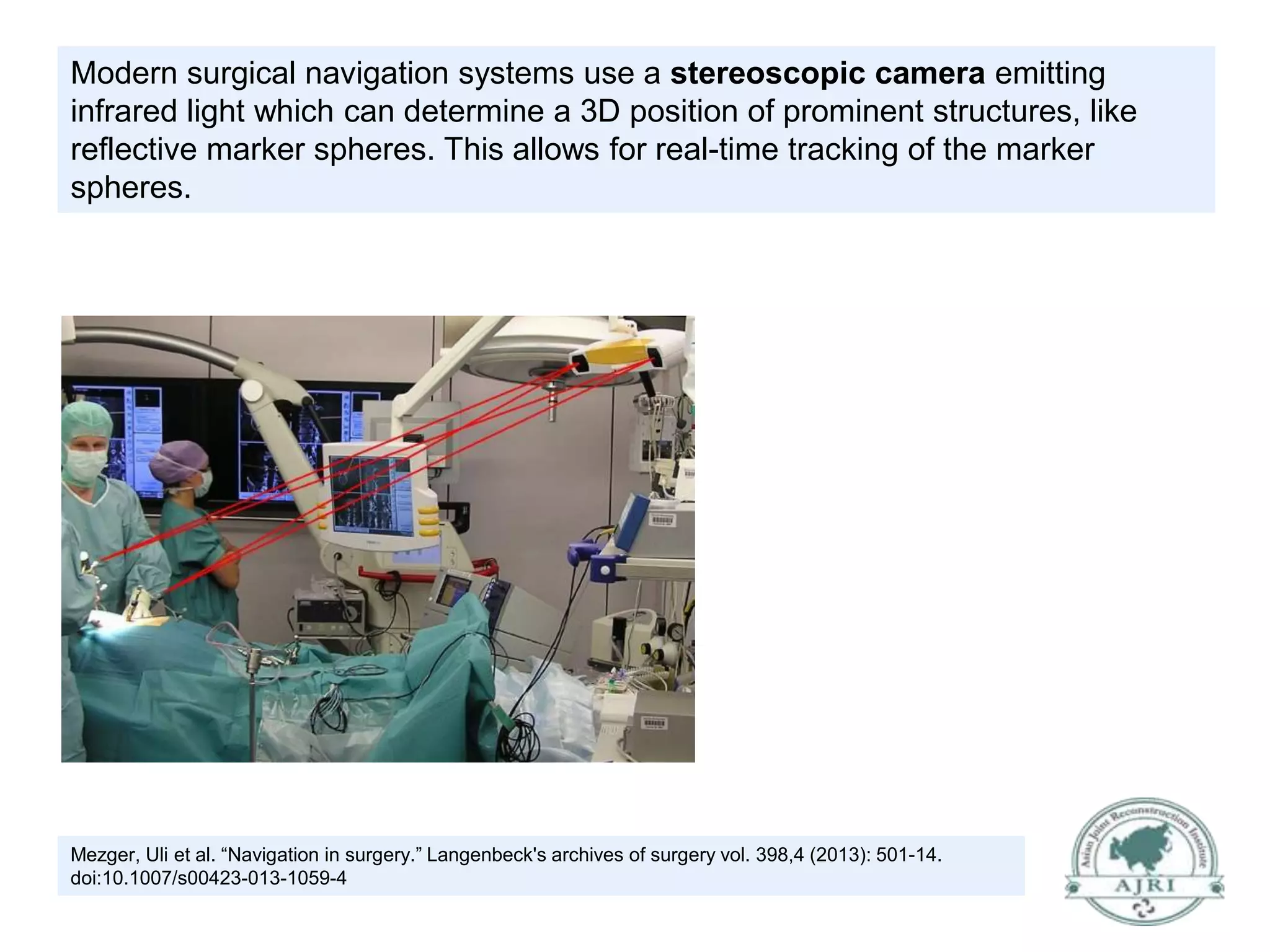 Introduction to Navigation Robotic Total Knee Replacement PPT