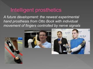A future development: the newest experimental
hand prosthesis from Otto Bock with individual
movement of fingers controlled by nerve signals
 