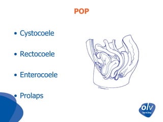 POP
• Cystocoele
• Rectocoele

• Enterocoele
• Prolaps

 