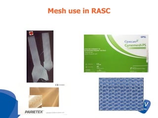Mesh use in RASC

 