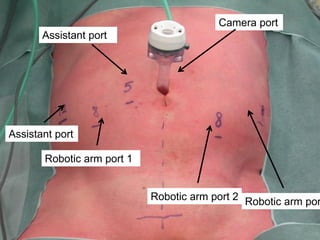 Camera port
Assistant port

Assistant port
Robotic arm port 1

Robotic arm port 2 Robotic arm por

 