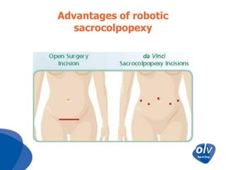 Advantages of robotic
sacrocolpopexy

 