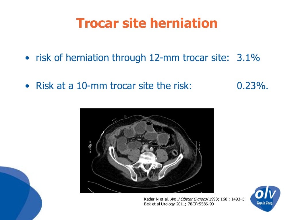 Robotic Sacrocolpopexy OLV