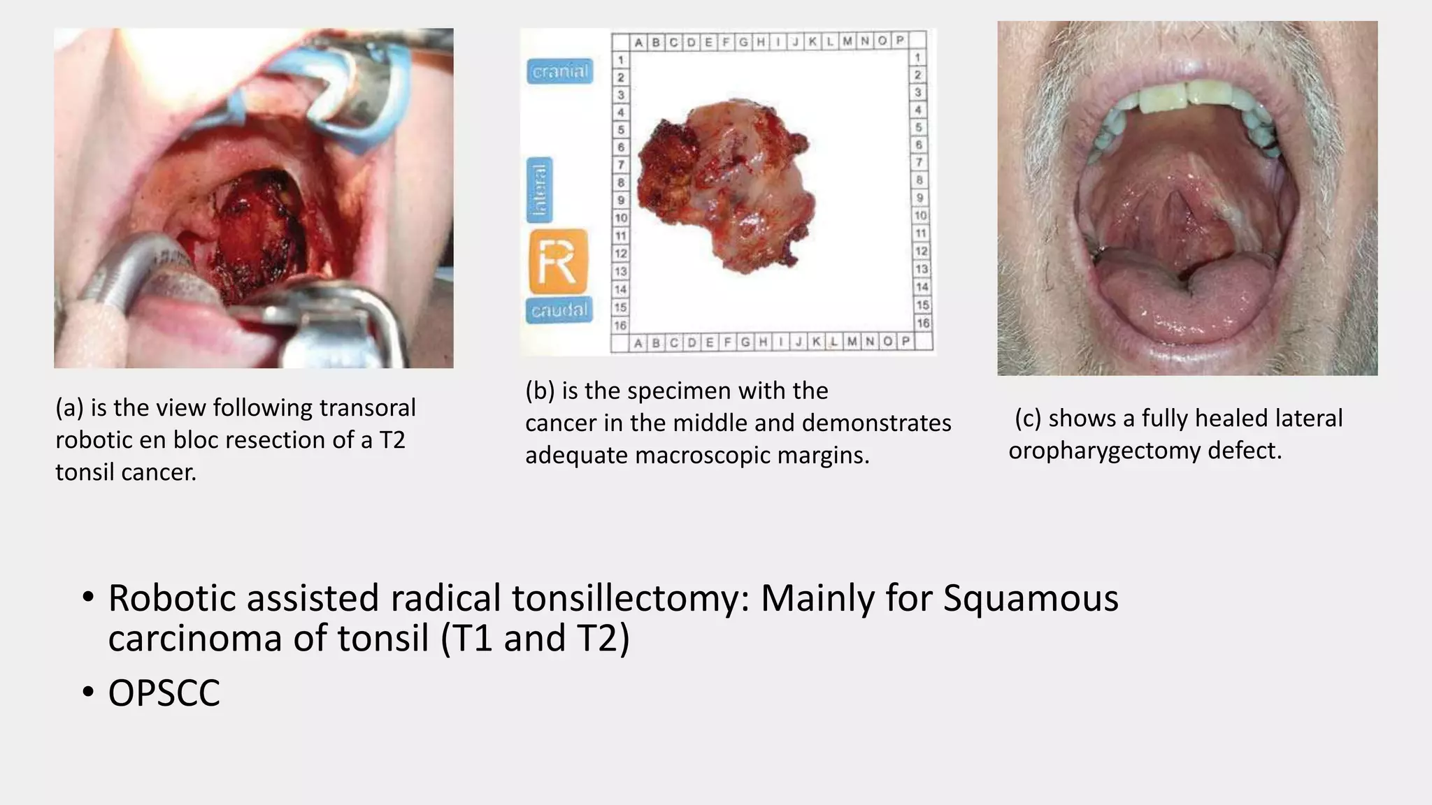 (a) is the view following transoral
robotic en bloc resection of a T2
tonsil cancer.
(b) is the specimen with the
cancer in the middle and demonstrates
adequate macroscopic margins.
(c) shows a fully healed lateral
oropharygectomy defect.
• Robotic assisted radical tonsillectomy: Mainly for Squamous
carcinoma of tonsil (T1 and T2)
• OPSCC
 