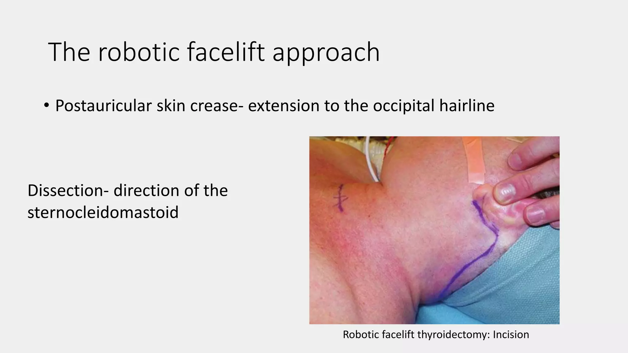 The robotic facelift approach
• Postauricular skin crease- extension to the occipital hairline
Dissection- direction of the
sternocleidomastoid
Robotic facelift thyroidectomy: Incision
 