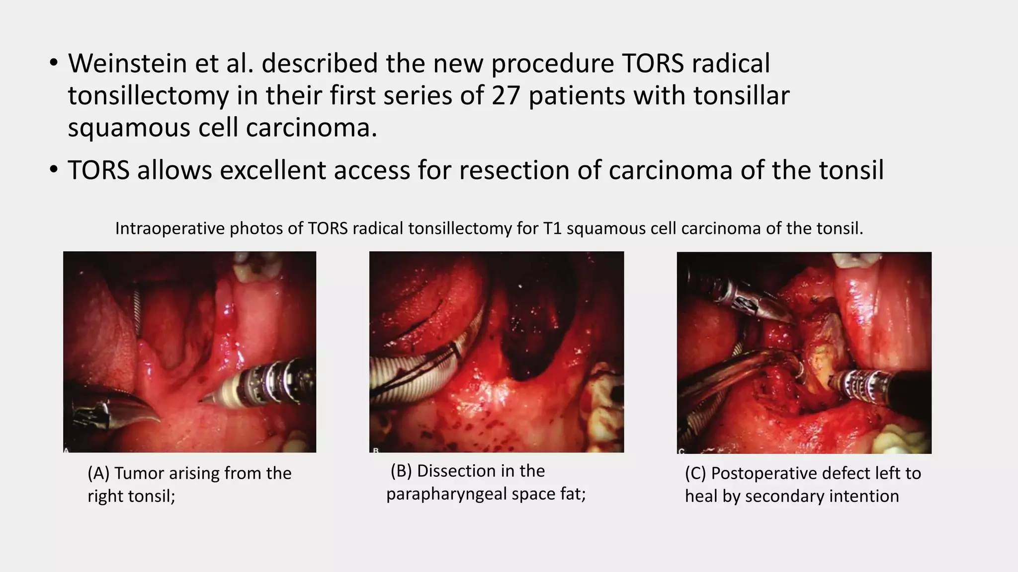 • Weinstein et al. described the new procedure TORS radical
tonsillectomy in their first series of 27 patients with tonsillar
squamous cell carcinoma.
• TORS allows excellent access for resection of carcinoma of the tonsil
Intraoperative photos of TORS radical tonsillectomy for T1 squamous cell carcinoma of the tonsil.
(A) Tumor arising from the
right tonsil;
(B) Dissection in the
parapharyngeal space fat;
(C) Postoperative defect left to
heal by secondary intention
 