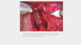 TORS view of base of tongue squamous cell carcinoma. 1. Base of tongue; 2.
Base of tongue SCC; 3. 5-mm Maryland dissection forceps; 4. Left Tonsillar
fossa; 5. Uvula. 6. 5-mm monopolar cautery.
 
