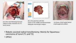 (a) is the view following transoral
robotic en bloc resection of a T2
tonsil cancer.
(b) is the specimen with the
cancer in the middle and demonstrates
adequate macroscopic margins.
(c) shows a fully healed lateral
oropharygectomy defect.
• Robotic assisted radical tonsillectomy: Mainly for Squamous
carcinoma of tonsil (T1 and T2)
• OPSCC
 