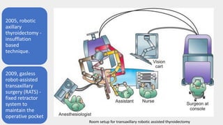 2005, robotic
axillary
thyroidectomy -
insufflation
based
technique.
2009, gasless
robot-assisted
transaxillary
surgery (RATS) -
fixed retractor
system to
maintain the
operative pocket
Room setup for transaxillary robotic assisted thyroidectomy
 