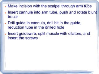  Make incision with the scalpel through arm tube
 Insert cannula into arm tube, push and rotate blunt
trocar
 Drill guide in cannula, drill bit in the guide,
reduction tube in the drilled hole
 Insert guidewire, split muscle with dilators, and
insert the screws
 