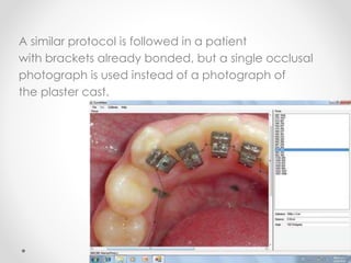 A similar protocol is followed in a patient
with brackets already bonded, but a single occlusal
photograph is used instead of a photograph of
the plaster cast.
 