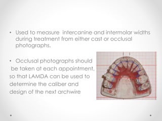 • Used to measure intercanine and intermolar widths
during treatment from either cast or occlusal
photographs.
• Occlusal photographs should
be taken at each appointment,
so that LAMDA can be used to
determine the caliber and
design of the next archwire
 