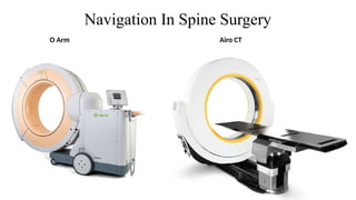 Navigation In Spine Surgery
Airo CT
O Arm
 