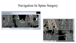 Navigation In Spine Surgery
 