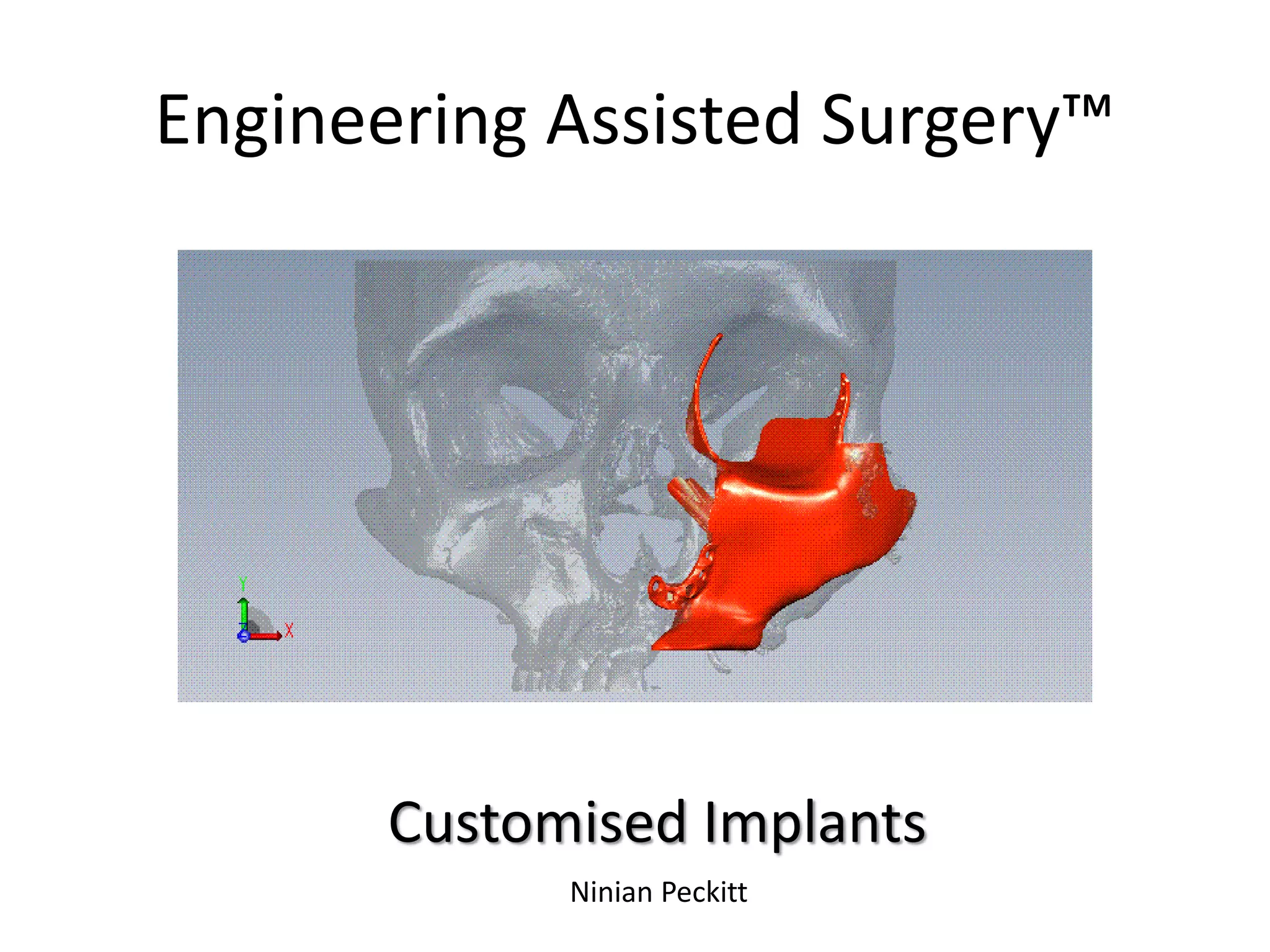 Engineering Assisted Surgery™
Customised Implants
Ninian Peckitt
 