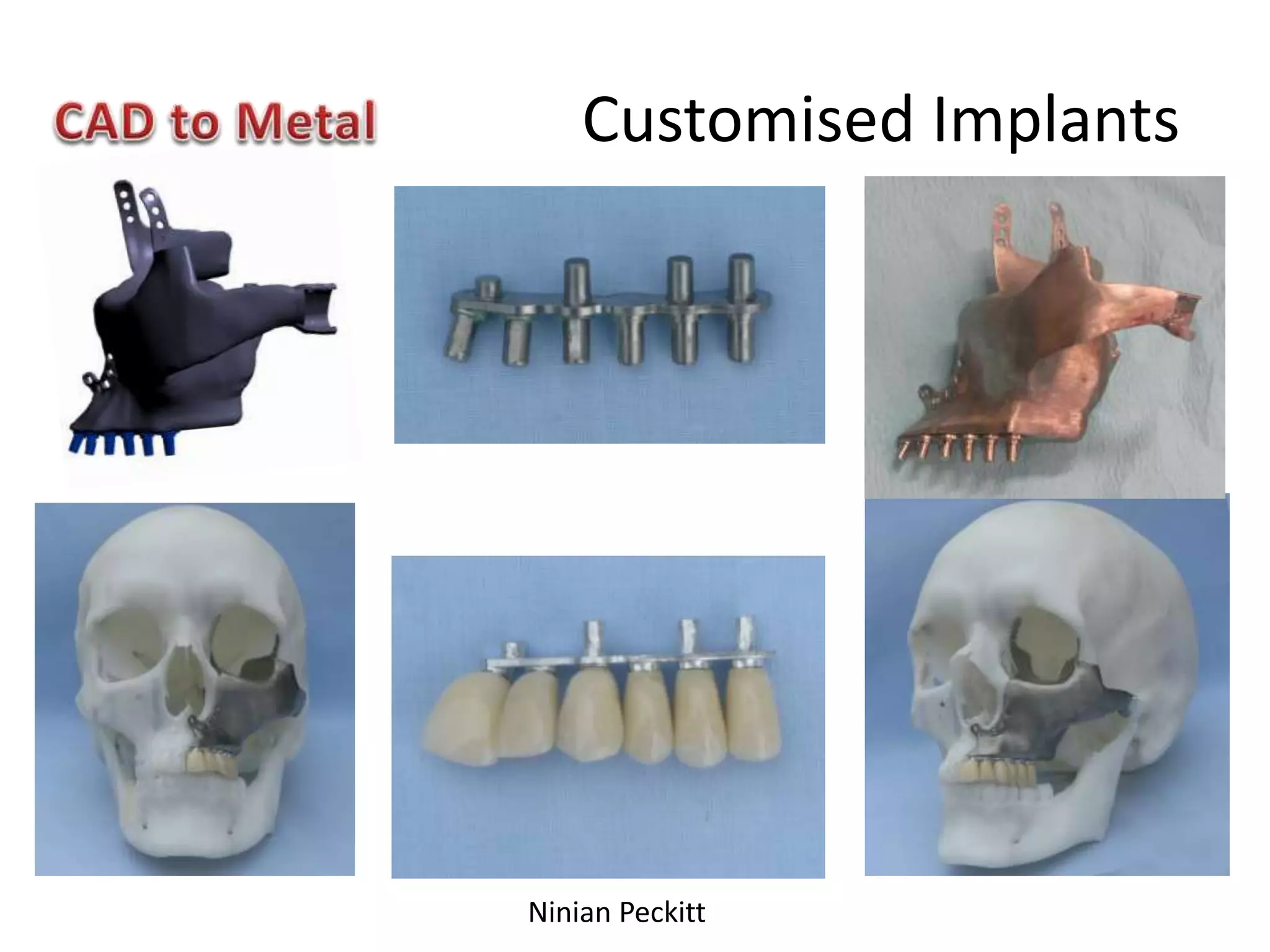 Customised Implants
Ninian Peckitt
 