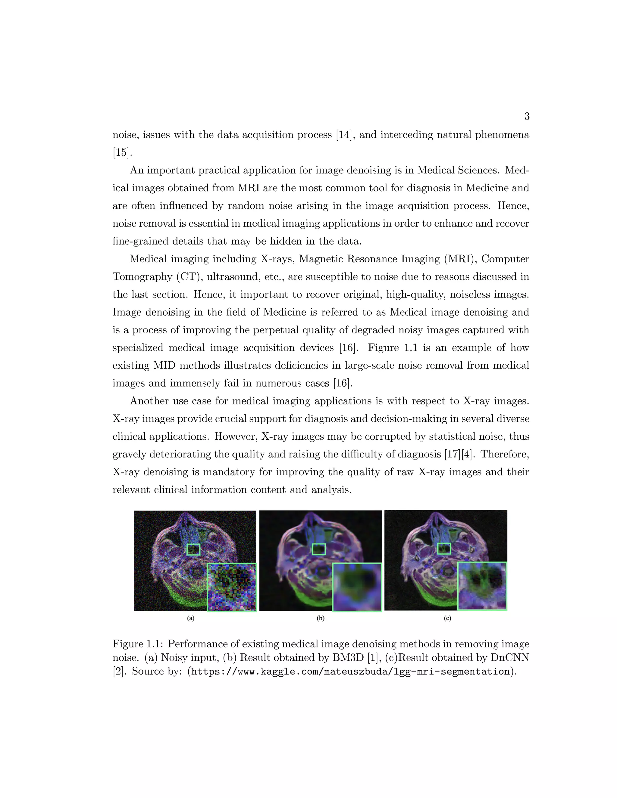 3 noise, issues with the data acquisition process [14], and interceding natural phenomena [15]. An important practical application for image denoising is in Medical Sciences. Med- ical images obtained from MRI are the most common tool for diagnosis in Medicine and are often influenced by random noise arising in the image acquisition process. Hence, noise removal is essential in medical imaging applications in order to enhance and recover fine-grained details that may be hidden in the data. Medical imaging including X-rays, Magnetic Resonance Imaging (MRI), Computer Tomography (CT), ultrasound, etc., are susceptible to noise due to reasons discussed in the last section. Hence, it important to recover original, high-quality, noiseless images. Image denoising in the field of Medicine is referred to as Medical image denoising and is a process of improving the perpetual quality of degraded noisy images captured with specialized medical image acquisition devices [16]. Figure 1.1 is an example of how existing MID methods illustrates deficiencies in large-scale noise removal from medical images and immensely fail in numerous cases [16]. Another use case for medical imaging applications is with respect to X-ray images. X-ray images provide crucial support for diagnosis and decision-making in several diverse clinical applications. However, X-ray images may be corrupted by statistical noise, thus gravely deteriorating the quality and raising the difficulty of diagnosis [17][4]. Therefore, X-ray denoising is mandatory for improving the quality of raw X-ray images and their relevant clinical information content and analysis. Figure 1.1: Performance of existing medical image denoising methods in removing image noise. (a) Noisy input, (b) Result obtained by BM3D [1], (c)Result obtained by DnCNN [2]. Source by: (https://www.kaggle.com/mateuszbuda/lgg-mri-segmentation). 