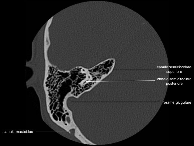 Anatomia Rocca TC - CT temporal bone anatomy