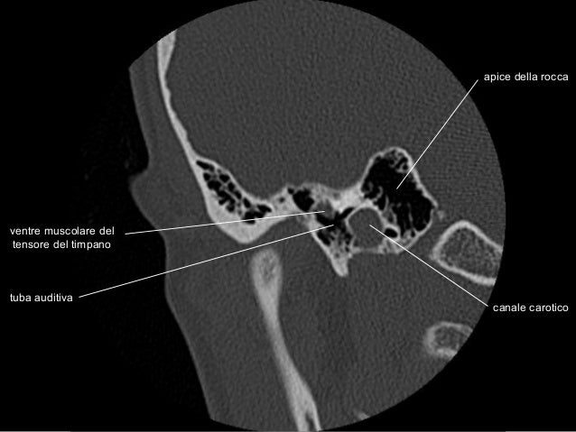 Anatomia Rocca TC - CT temporal bone anatomy